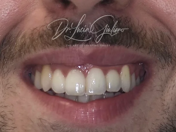 Gummy Smile - medicina estetica