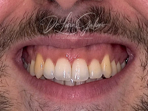 Gummy Smile - medicina estetica