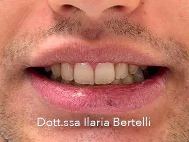 Ortodonzia trasparente